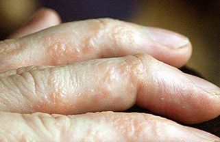 Homeopathic Medicines for Pompholyx - Natural Remedies