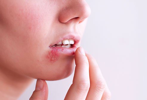 Epstein-Barr Virus - Homeopathic Medicines for EBV