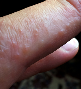 Homeopathic medicines for dermatitis herpetiformis