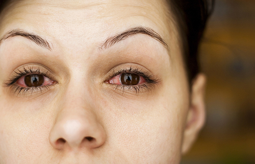 Homeopathic medicines for scleritis - DrHomeo Homeopathy