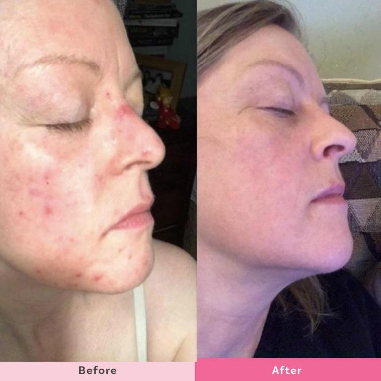 How The Healthy Mummy helped a mum who suffered from acne her whole adult life