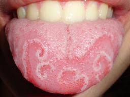 Homeopathic Medicines for Geographic Tongue