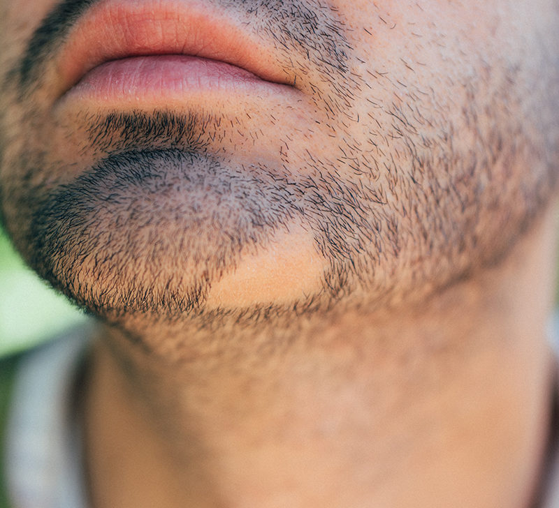 Homeopathic medicines for alopecia barbae - DrHomeo Homeopathy