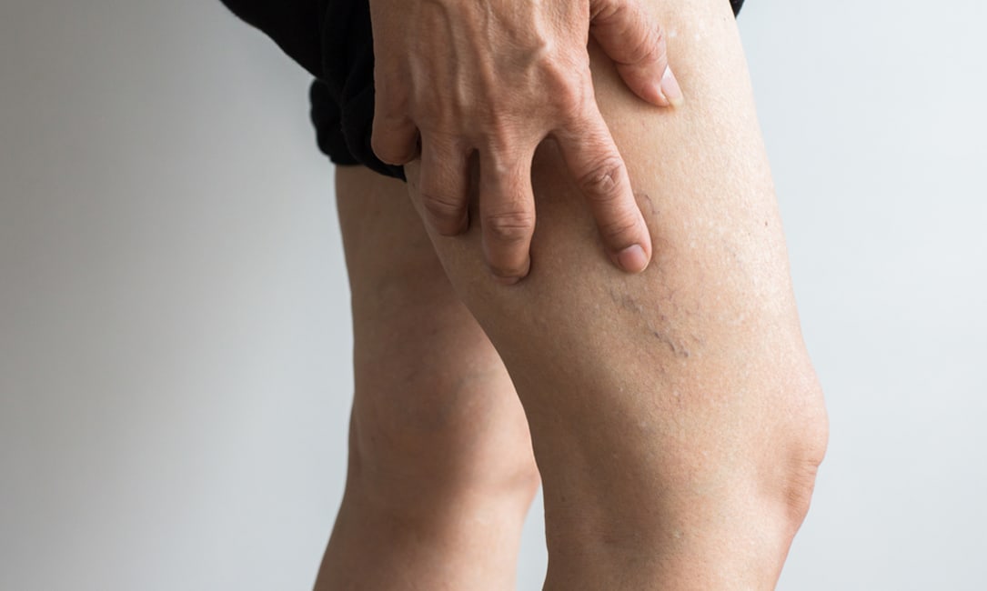 Homeopathic Medicines for Thrombosis - DrHomeo Homeopathy