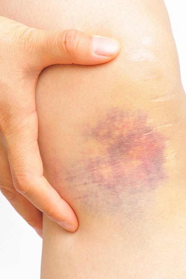 Homeopathic treatment for bruises - DrHomeo Homeopathy