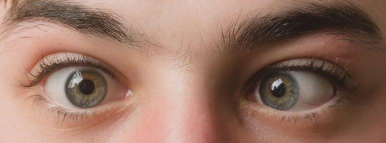 9 Supportive Homeopathic Remedies for Lazy Eye 
