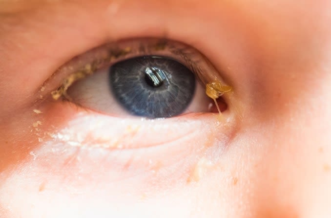 11 Homeopathic remedies for eye discharge- DrHomeo Homeopathy
