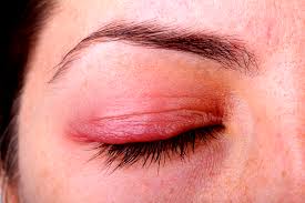 Homeopathic Medicines for Atopic Keratoconjunctivitis 