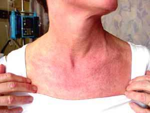Symptomatic Treatment - Homeopathy for Polymyositis