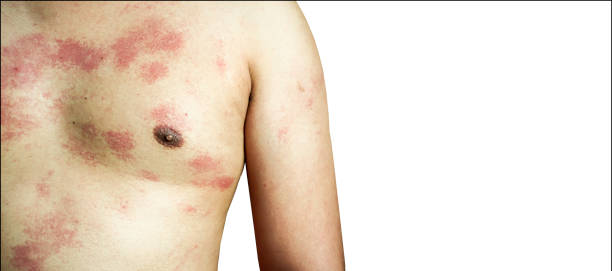 Homeopathic remedies for erysipelas - DrHomeo Homeopathy