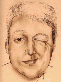 Homeopathic remedies for hemifacial spasm - DrHomeo Homeopathy