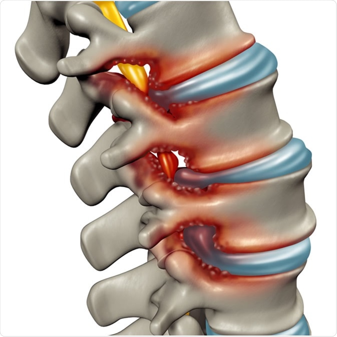 Homeopathy for spinal stenosis - Supportive Treatment DrHomeo