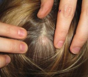 Homeopathic Medicines for Pilar Cysts 