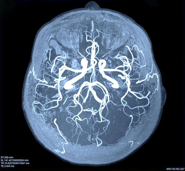 Beta Blockers May Help With Malformations in Brain Vessels