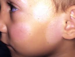 Homeopathic medicines for pityriasis alba