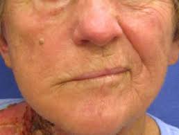 Homeopathic medicines for Ramsay Hunt Syndrome