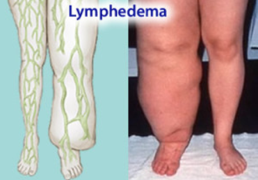 Liposuction and Lymphedema?